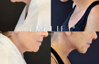 female patient before and after EVELIFT®