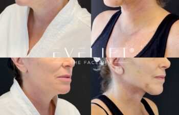female patient before and after EVELIFT®