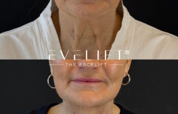 female patient before and after EVELIFT®