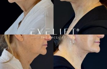 female patient before and after EVELIFT®