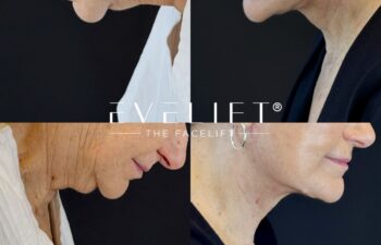 female patient before and after EVELIFT®