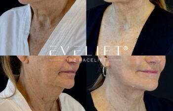 female patient before and after EVELIFT®
