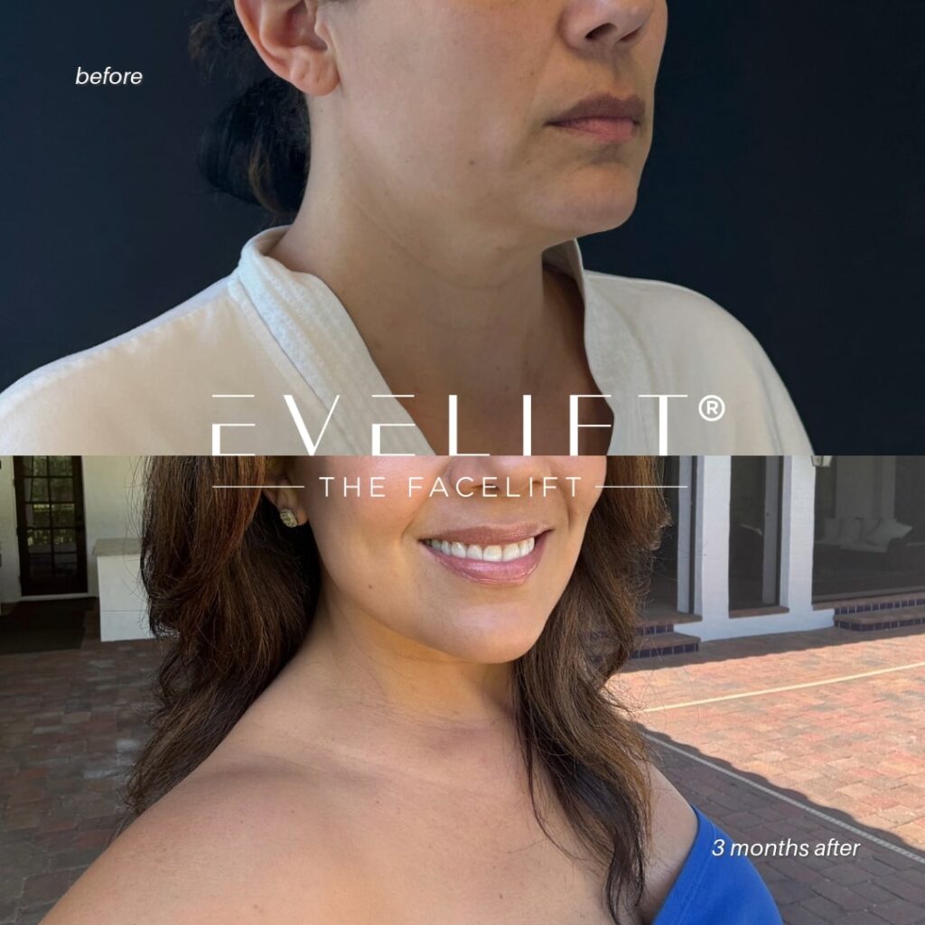female patient before and after EVELIFT®