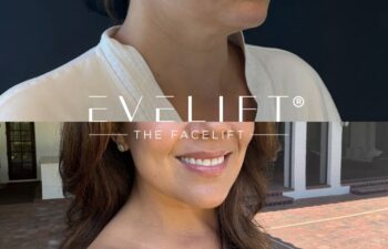 female patient before and after EVELIFT®