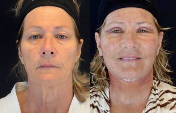 female patient before and after EVELIFT®