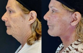 female patient before and after EVELIFT®