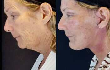 female patient before and after EVELIFT®