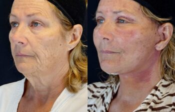 female patient before and after EVELIFT®
