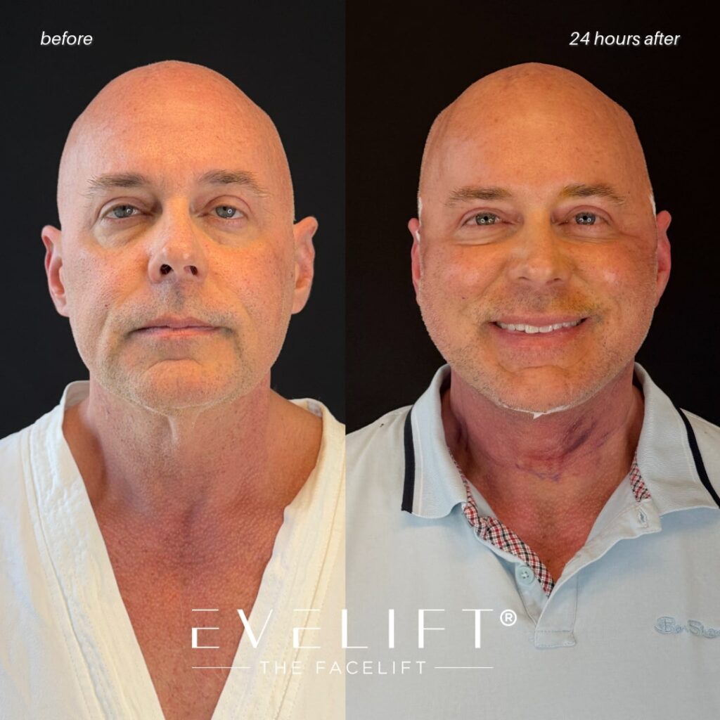 male patient before and after EVELIFT®
