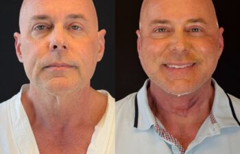 male patient before and after EVELIFT®