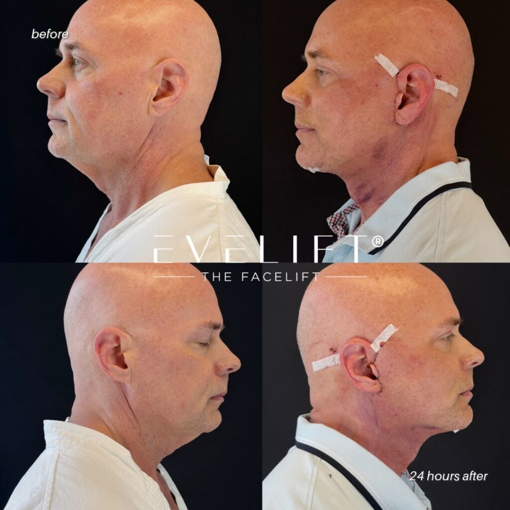 male patient before and after EVELIFT®