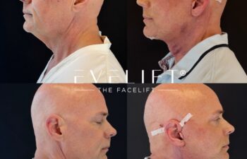male patient before and after EVELIFT®