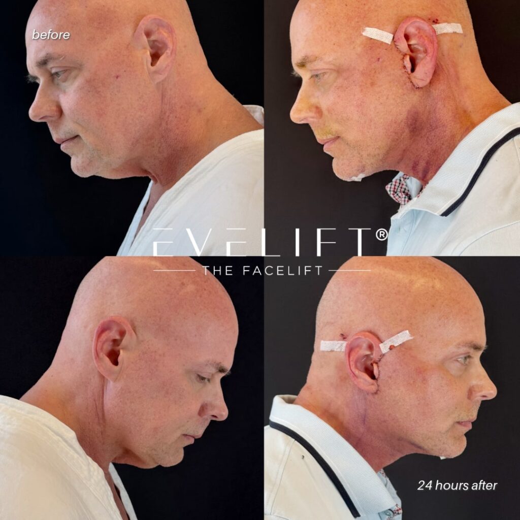 male patient before and after EVELIFT®
