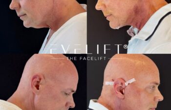 male patient before and after EVELIFT®