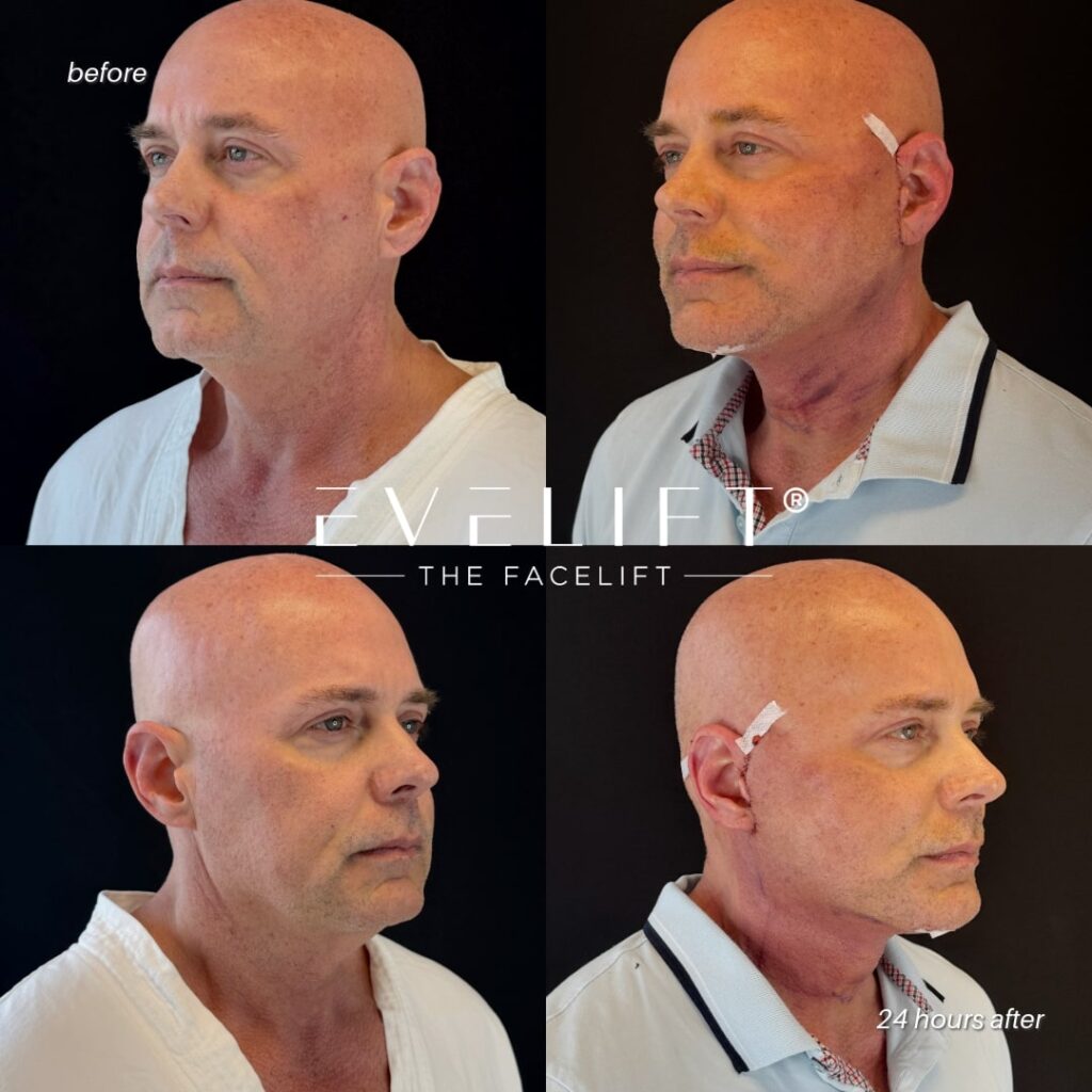 male patient before and after EVELIFT®