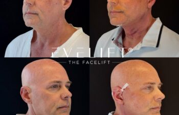 male patient before and after EVELIFT®