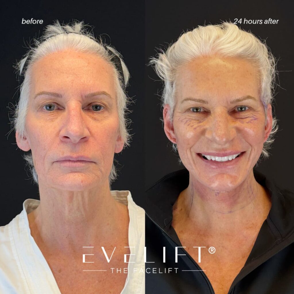 female patient before and after EVELIFT®