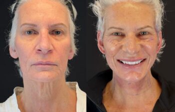 female patient before and after EVELIFT®