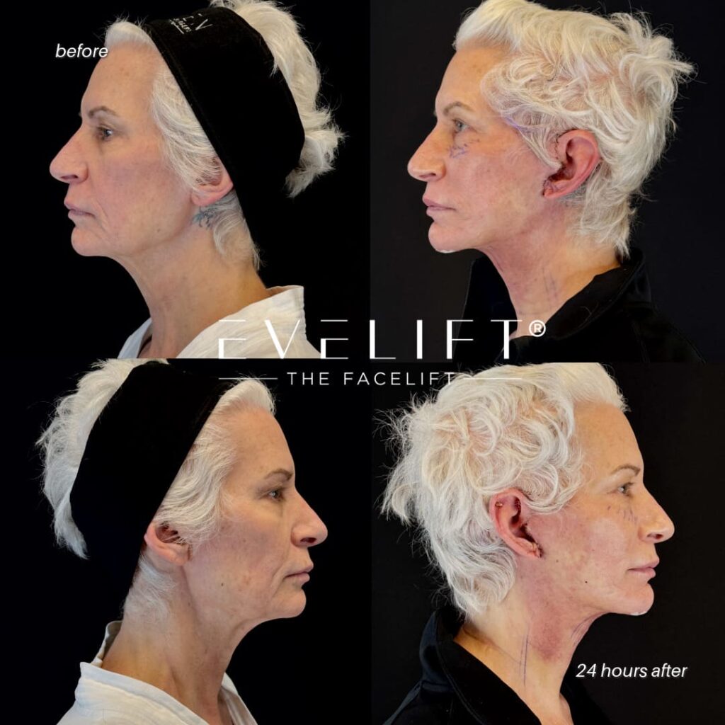 female patient before and after EVELIFT®