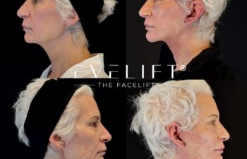 female patient before and after EVELIFT®