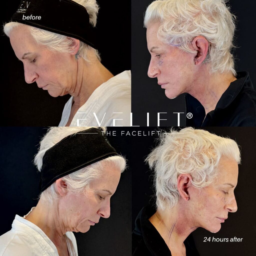 female patient before and after EVELIFT®