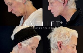 female patient before and after EVELIFT®