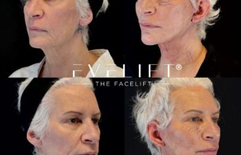 female patient before and after EVELIFT®