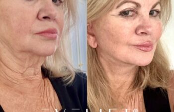 female patient before and after EVELIFT®