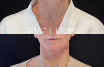 female patient before and after EVELIFT®