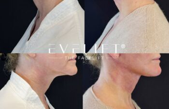 female patient before and after EVELIFT®