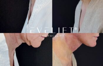 female patient before and after EVELIFT®