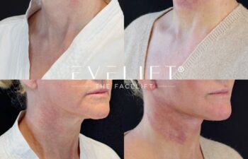 female patient before and after EVELIFT®