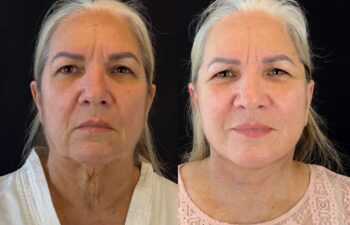 female patient before and after EVELIFT®