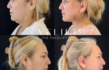 female patient before and after EVELIFT®