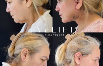 female patient before and after EVELIFT®