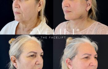female patient before and after EVELIFT®