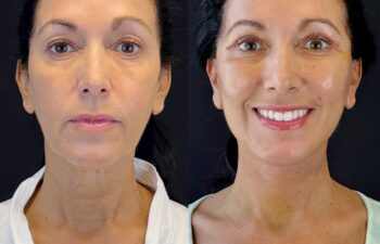 female patient before and after EVELIFT®