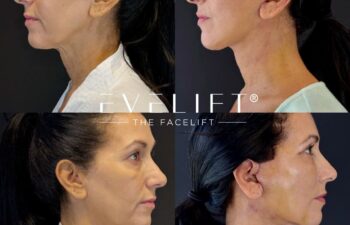 female patient before and after EVELIFT®