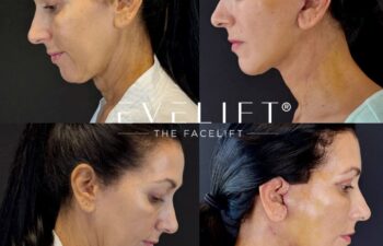 female patient before and after EVELIFT®