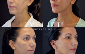 female patient before and after EVELIFT®