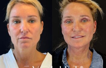 female patient before and after EVELIFT®