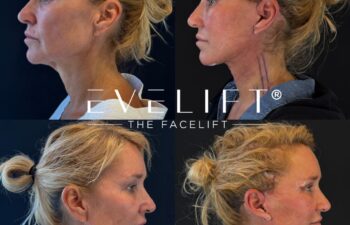 female patient before and after EVELIFT®
