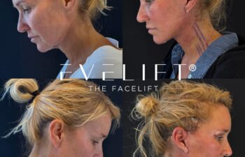 female patient before and after EVELIFT®