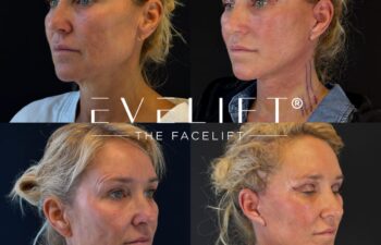 female patient before and after EVELIFT®