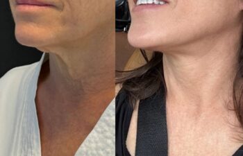 female patient before and after EVELIFT®