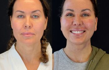 female patient before and after EVELIFT®