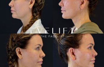 female patient before and after EVELIFT®