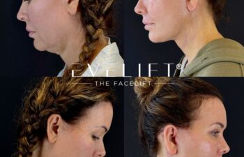 female patient before and after EVELIFT®