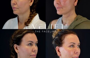 female patient before and after EVELIFT®