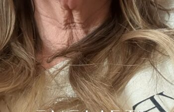 female patient before and after EVELIFT®